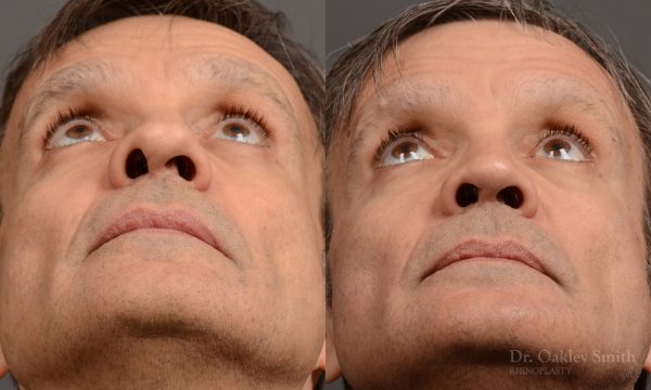 male hump reduction