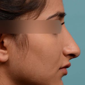 Shorten nose rhinoplasty