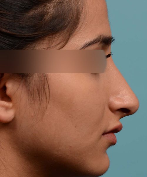 Shorten nose rhinoplasty