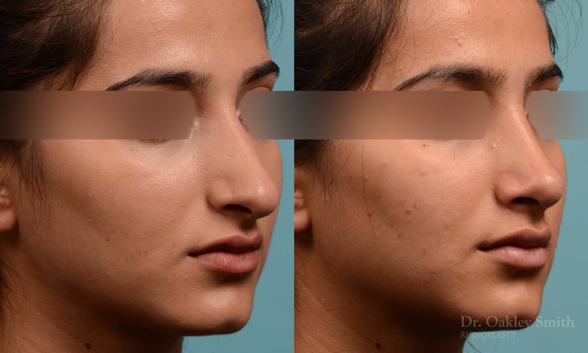 Shorten nose rhinoplasty