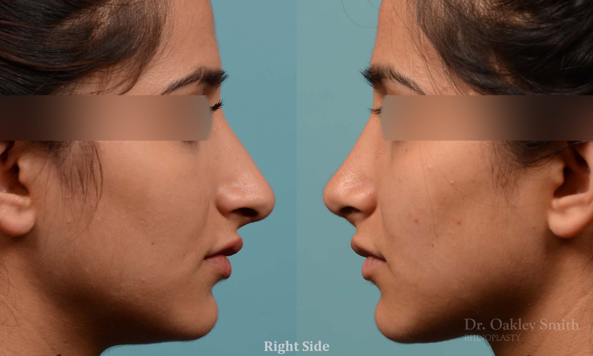 Shorten nose rhinoplasty