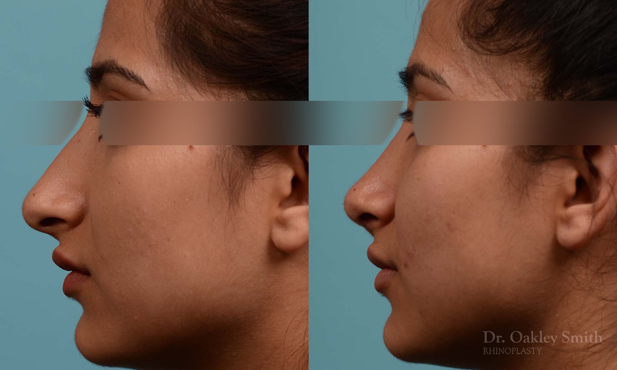 Shorten nose rhinoplasty