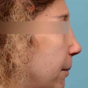 Revision Rhinoplasty