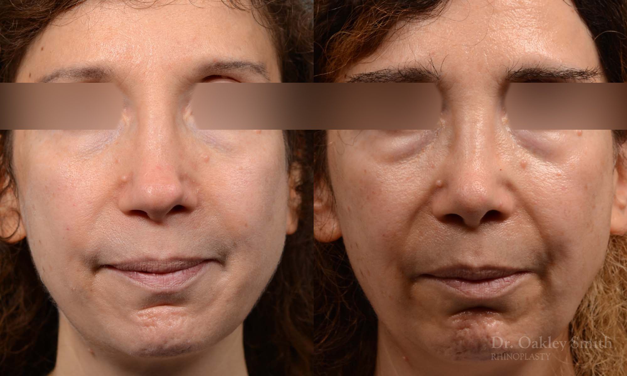 Revision Rhinoplasty