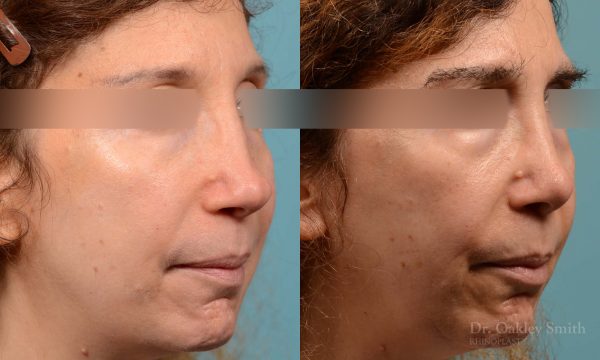 Revision Rhinoplasty