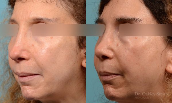 Revision Rhinoplasty