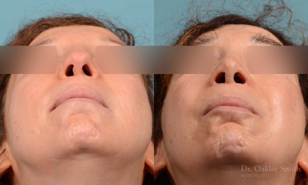 Revision Rhinoplasty