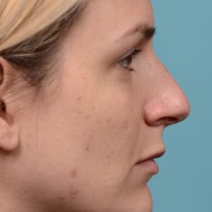 curved nose rhinoplasty
