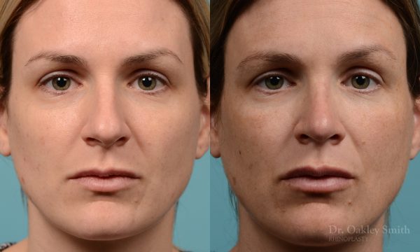 Hump reduction rhinoplasty to create a more feminine nose