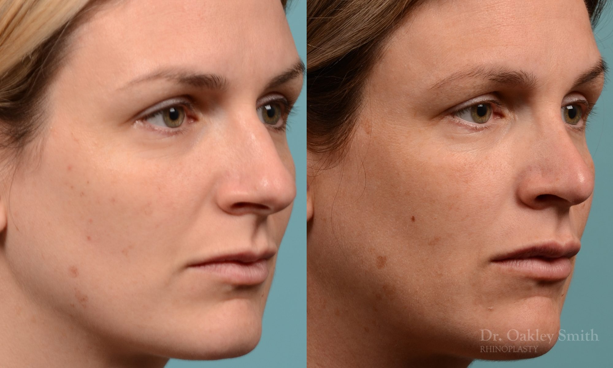 Hump reduction rhinoplasty to create a more feminine nose