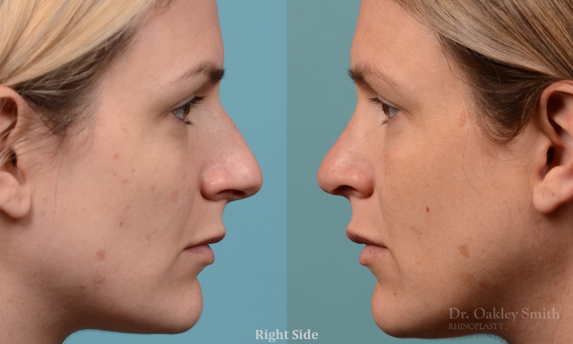 Hump reduction rhinoplasty to create a more feminine nose