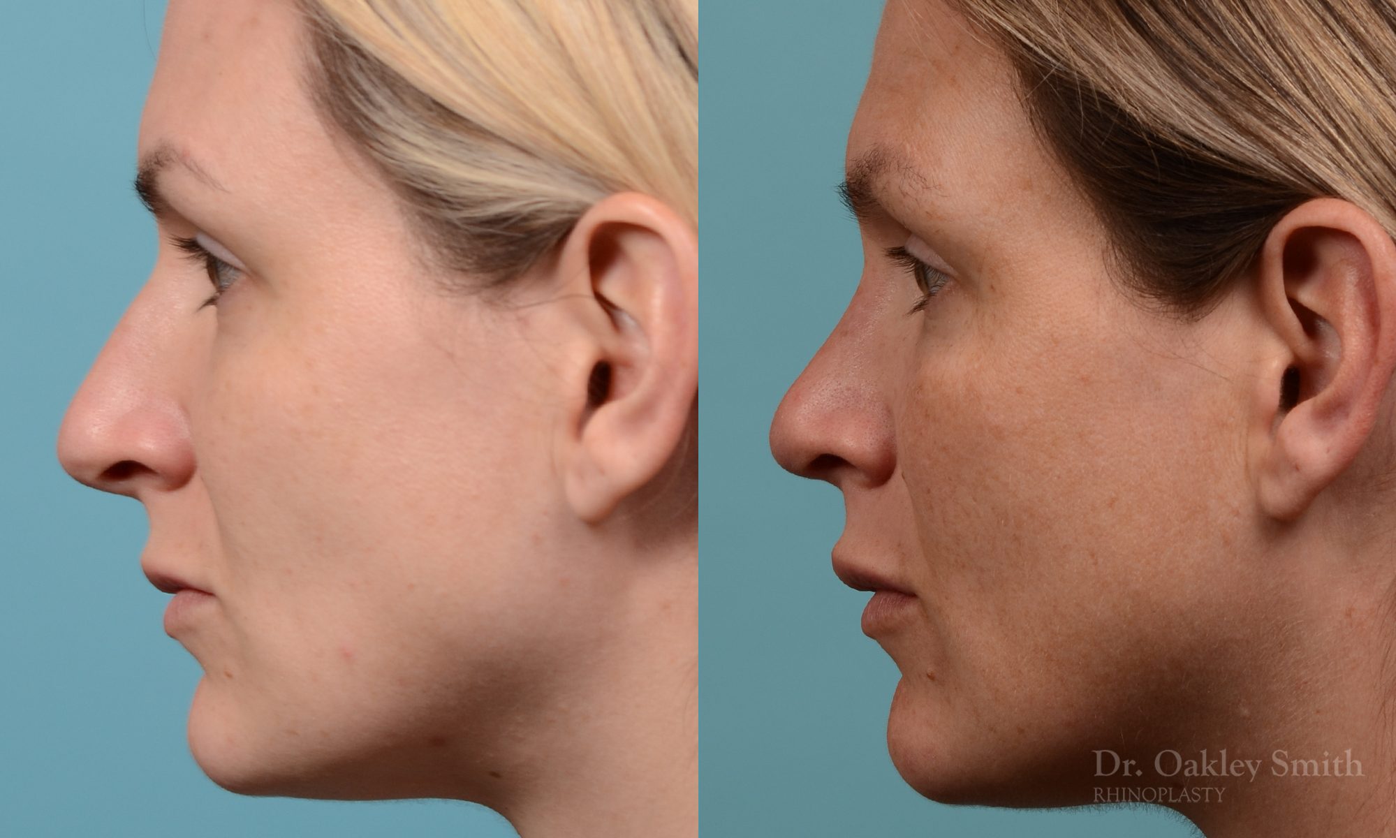 Hump reduction rhinoplasty to create a more feminine nose