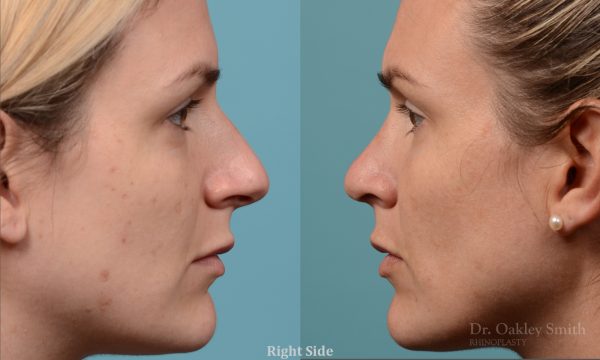 curved nose rhinoplasty
