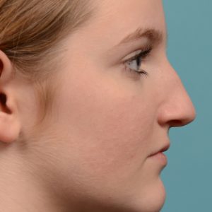 Hump reduction rhinoplasty young female