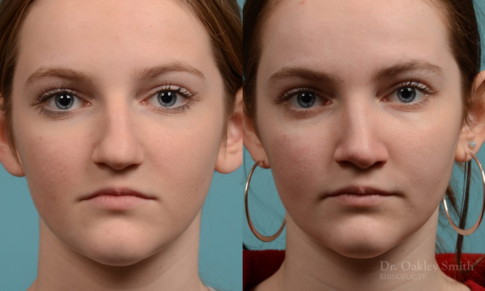 Female nose rhinoplasty remove curvature
