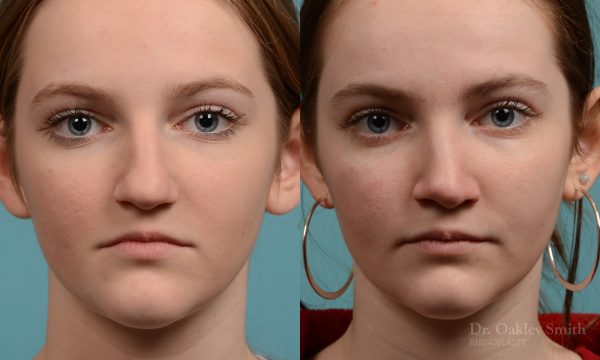 Female nose rhinoplasty remove curvature