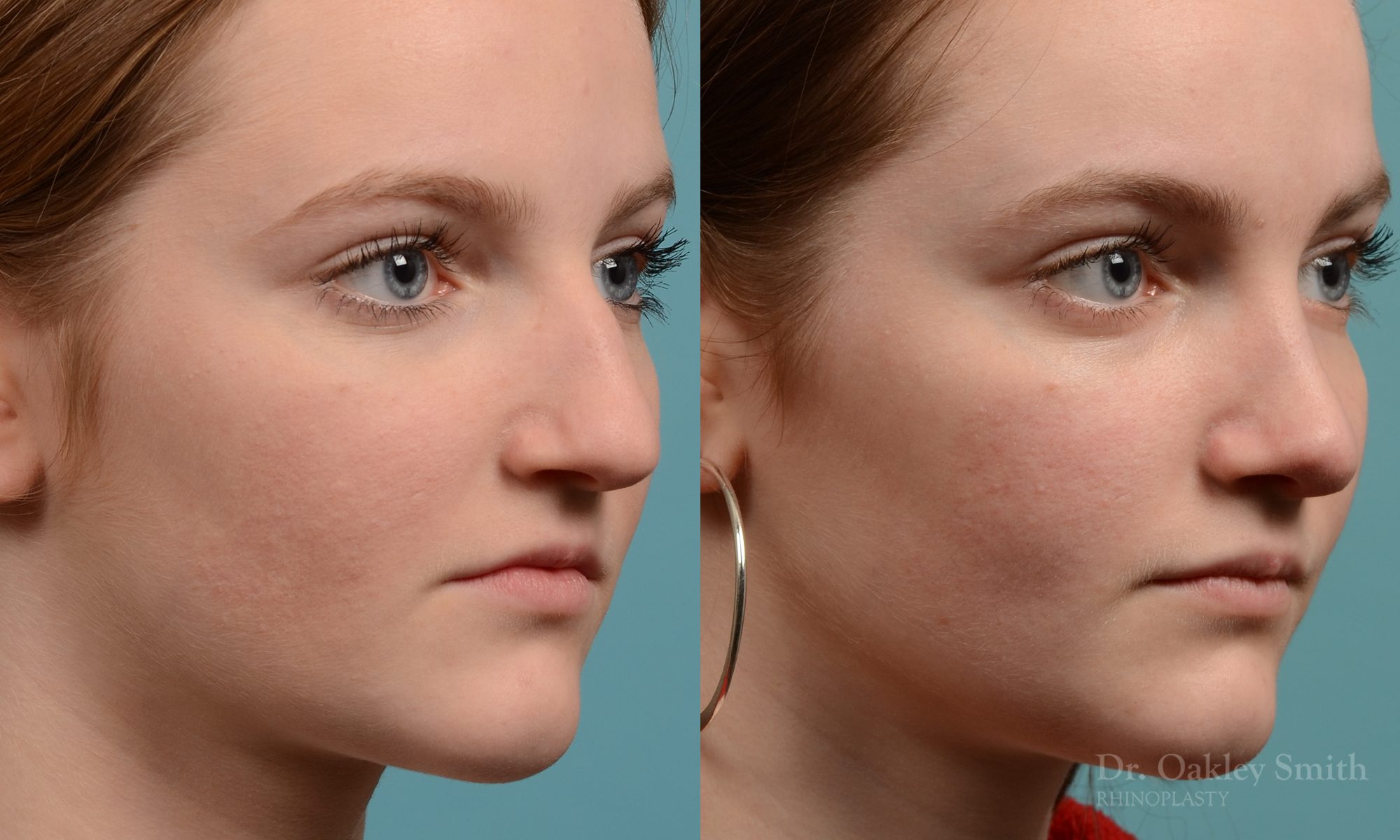 Female nose rhinoplasty remove curvature