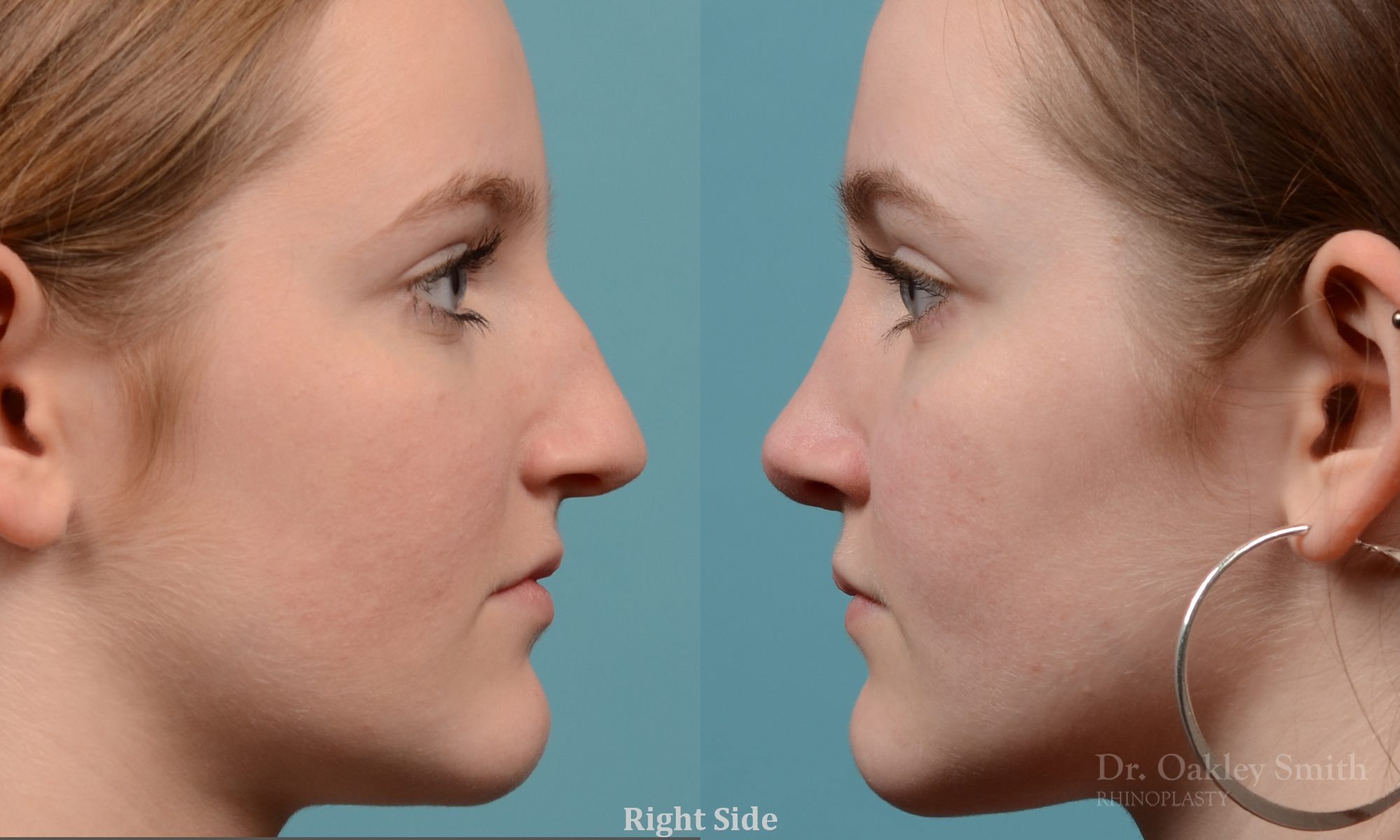 Female nose rhinoplasty remove curvature