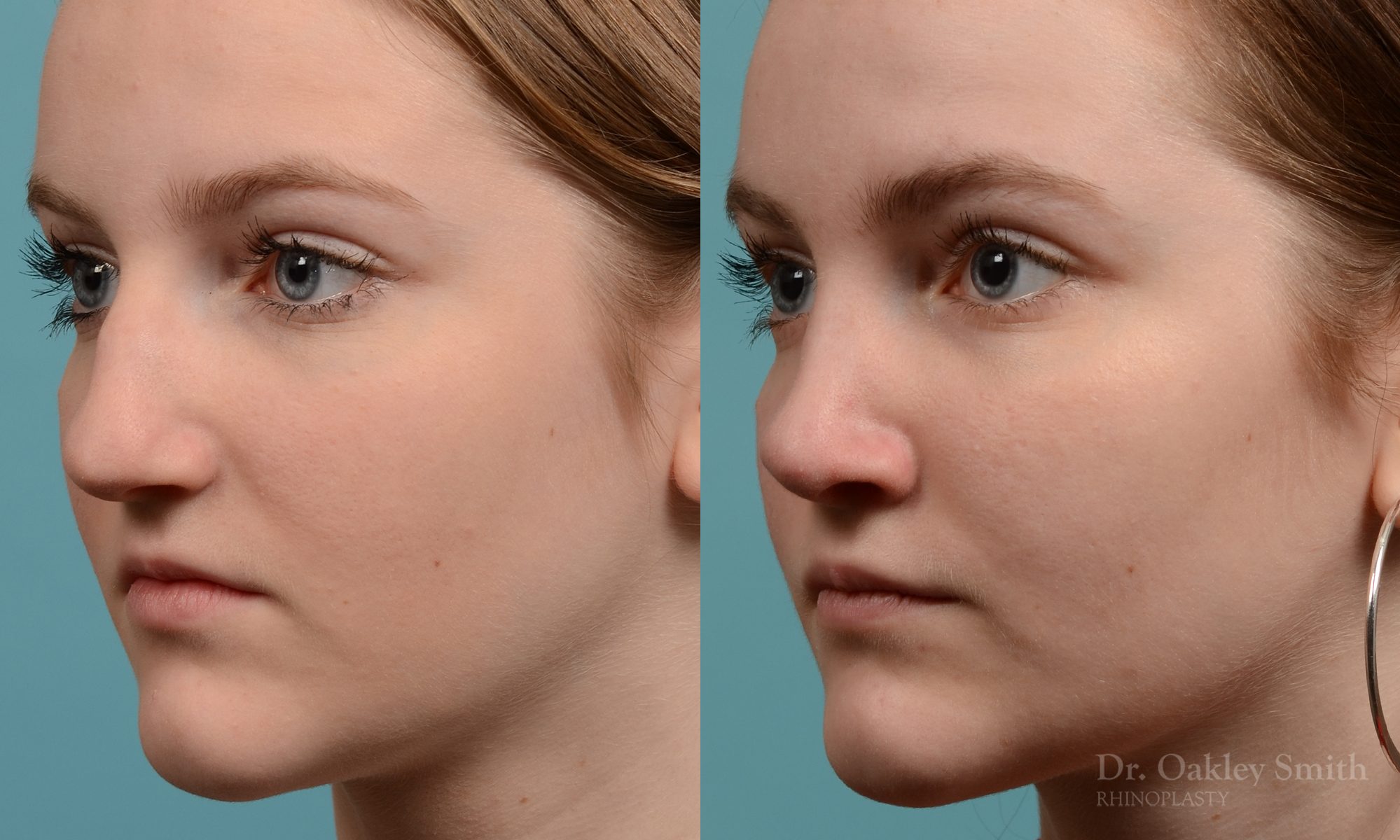 Female nose rhinoplasty remove curvature
