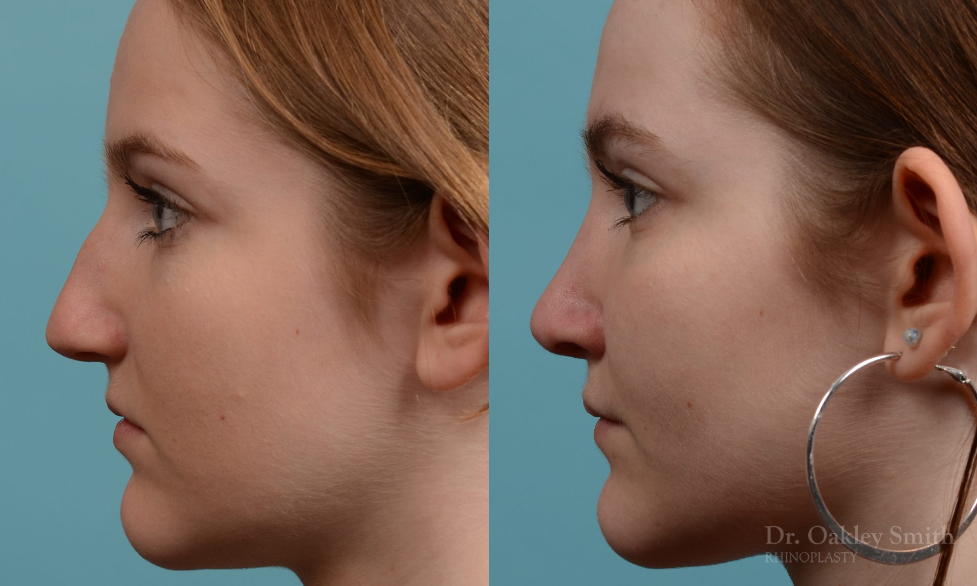 Female nose rhinoplasty remove curvature