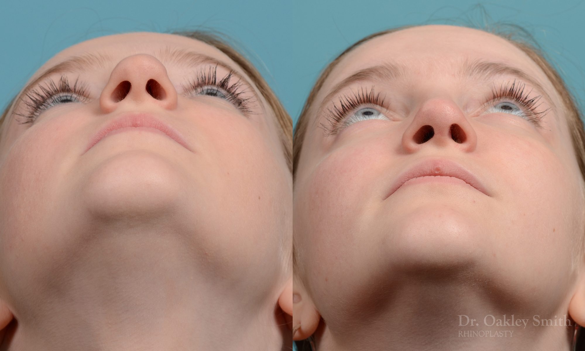Female nose rhinoplasty remove curvature