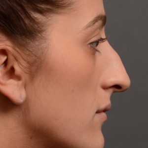 Feminine curved nose post rhinoplasty