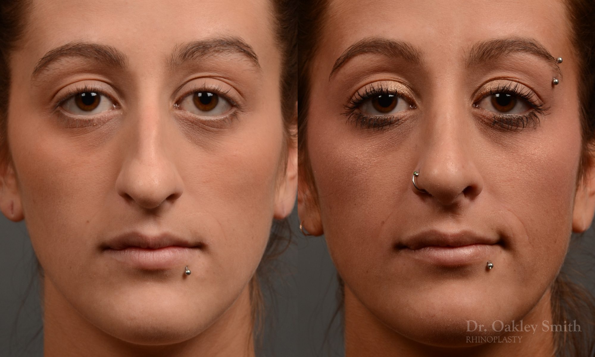 Hump reduction rhinoplasty to create a more feminine nose