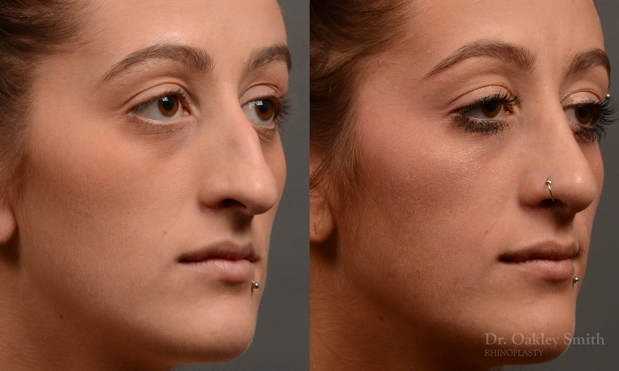 Hump reduction rhinoplasty to create a more feminine nose