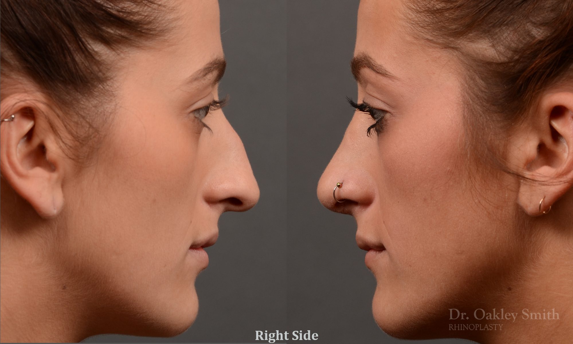 Hump reduction rhinoplasty to create a more feminine nose