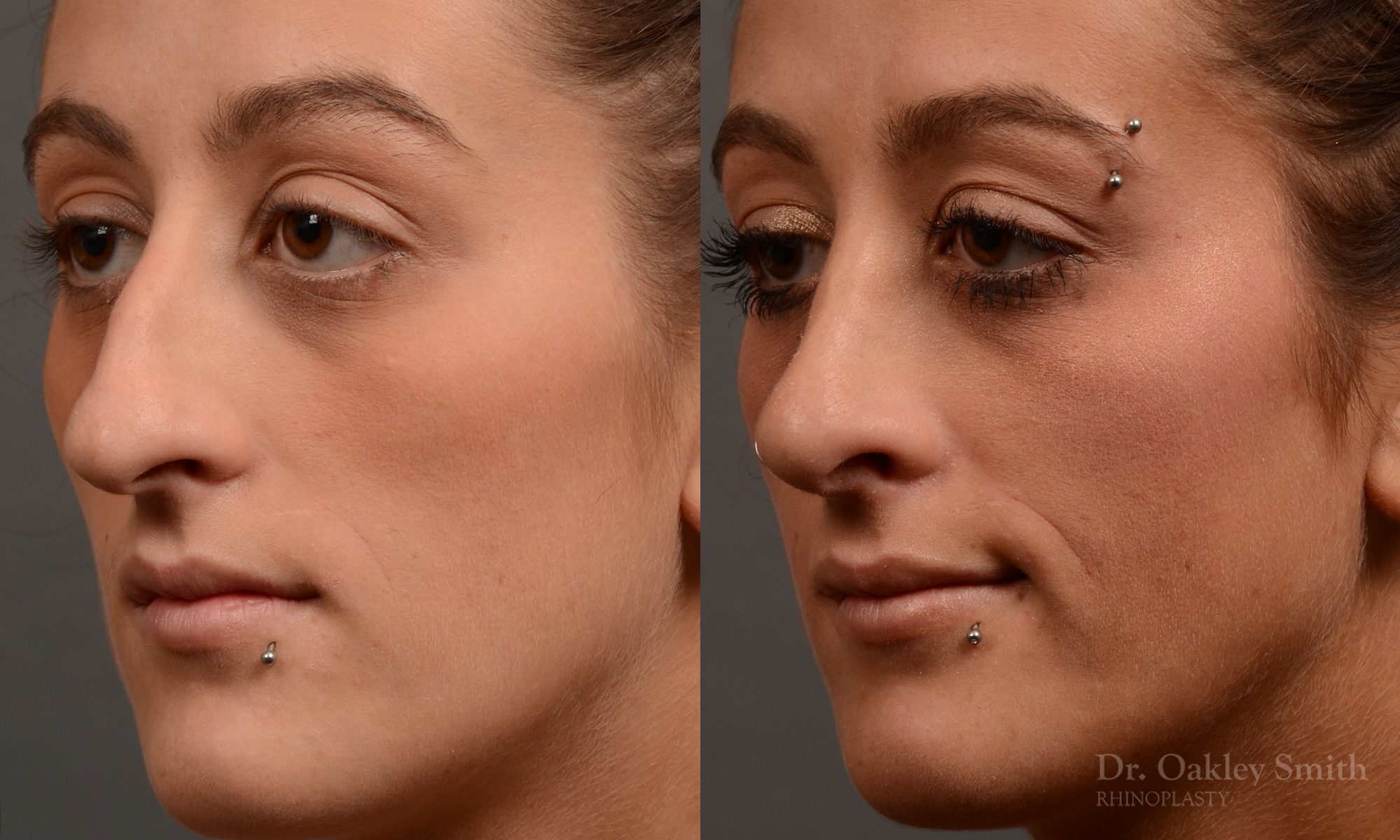 Hump reduction rhinoplasty to create a more feminine nose