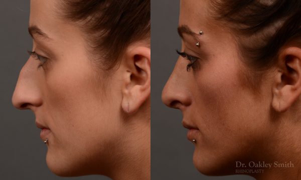 Hump reduction rhinoplasty to create a more feminine nose