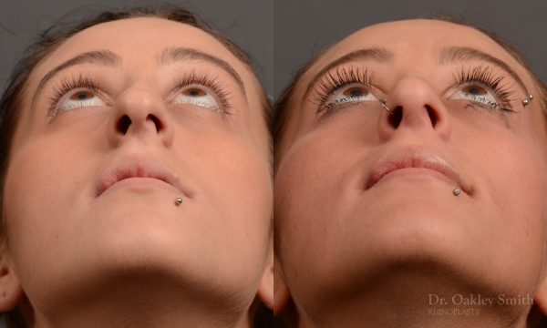 Hump reduction rhinoplasty to create a more feminine nose