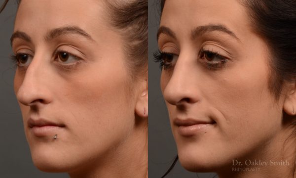 Feminine curved nose post rhinoplasty