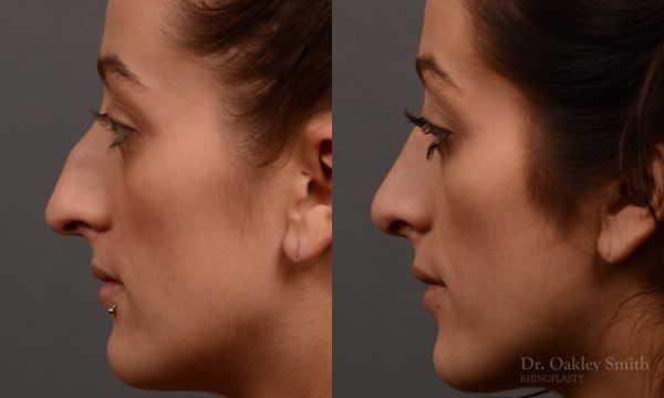 Feminine curved nose post rhinoplasty