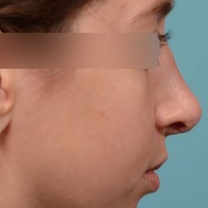 Expert Rhinoplasty nose job surgery to reduce the size of this womans nose.