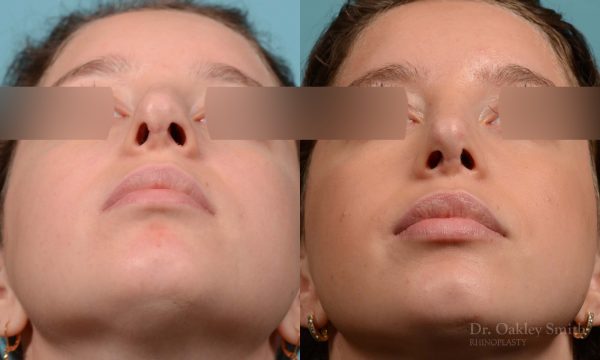 Expert Rhinoplasty nose job surgery to reduce the size of this womans nose.