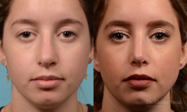 Septoplasty rhinoplasty nose surgery