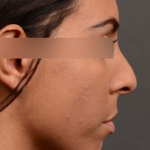 Hump reduction female rhinoplasty