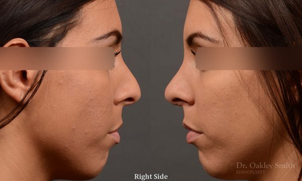 nose hump reduction rhinoplasty female nose job