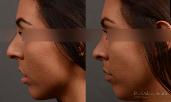 nose hump reduction rhinoplasty female nose job