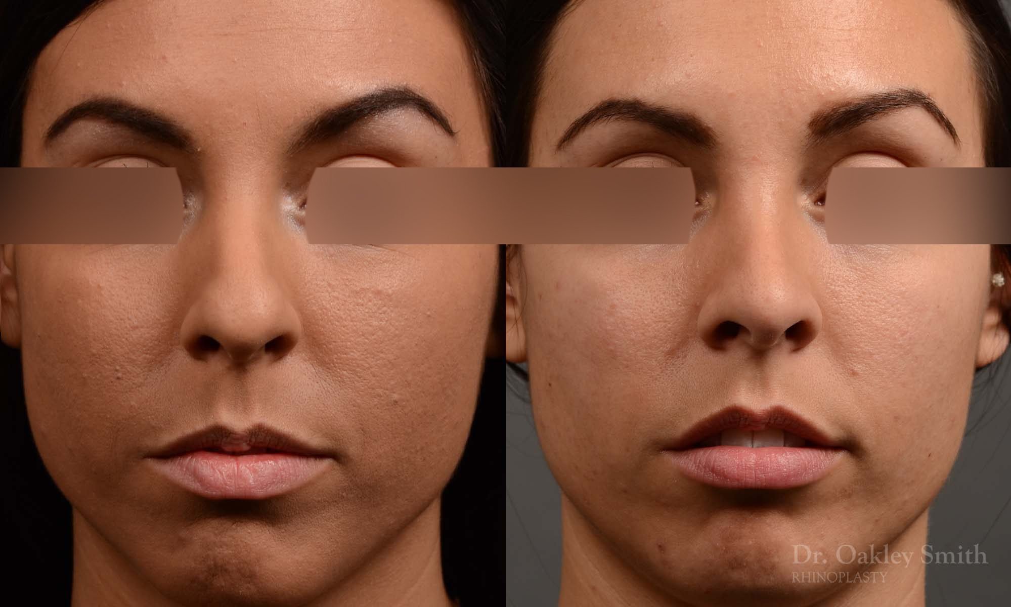 rhinoplasty Nothing demonstrates the skillful craftsmanship that Dr. Oakley Smith accomplishes during his surgeries than a collection of before and after case studies. As one of a hand full of surgeons in North America who limits his practice to only Rhinoplasty surgery, it is obvious that he has mastered his art. There is no question why he is one of the busiest cosmetic nose job surgeons in the country.