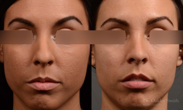 rhinoplasty Nothing demonstrates the skillful craftsmanship that Dr. Oakley Smith accomplishes during his surgeries than a collection of before and after case studies. As one of a hand full of surgeons in North America who limits his practice to only Rhinoplasty surgery, it is obvious that he has mastered his art. There is no question why he is one of the busiest cosmetic nose job surgeons in the country.