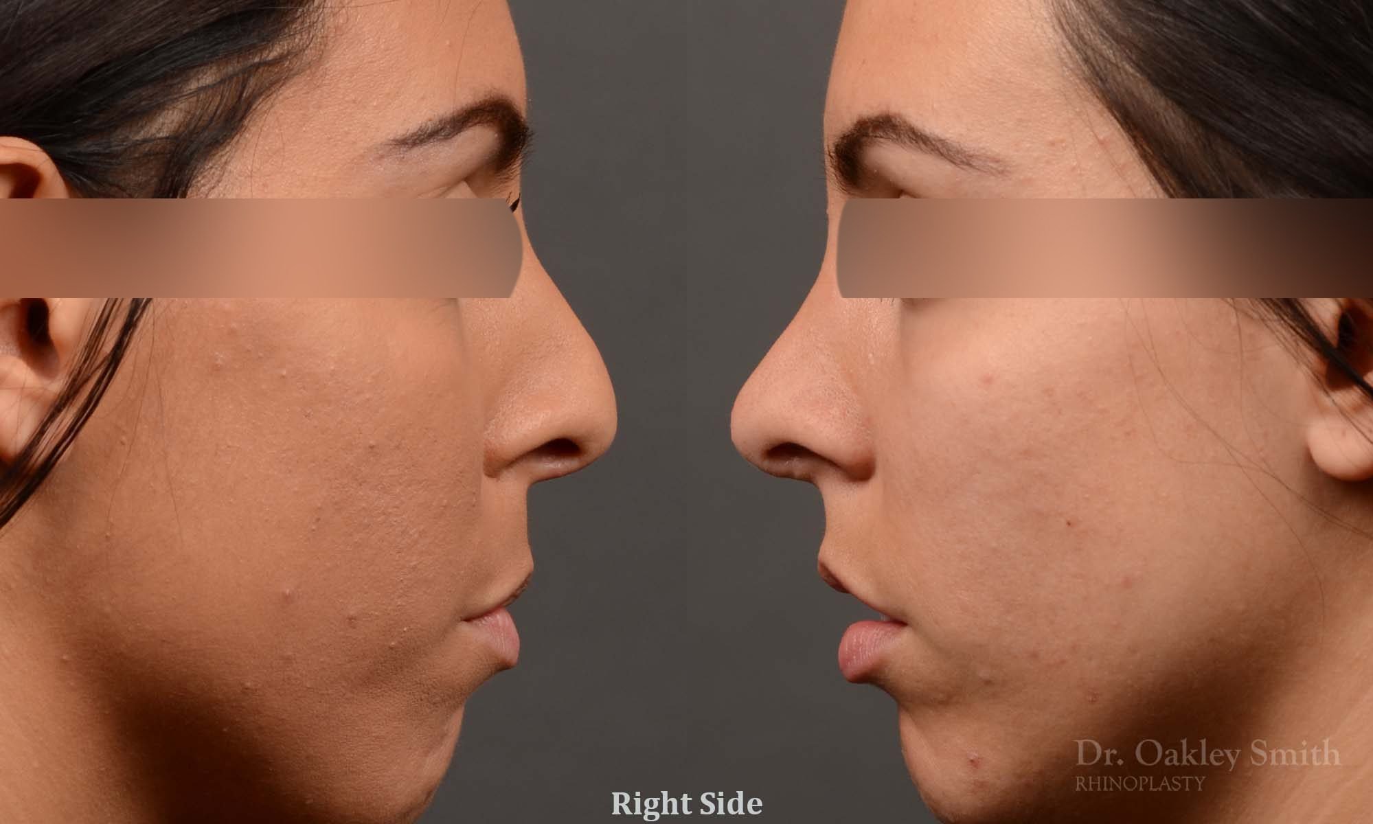 rhinoplasty Nothing demonstrates the skillful craftsmanship that Dr. Oakley Smith accomplishes during his surgeries than a collection of before and after case studies. As one of a hand full of surgeons in North America who limits his practice to only Rhinoplasty surgery, it is obvious that he has mastered his art. There is no question why he is one of the busiest cosmetic nose job surgeons in the country.