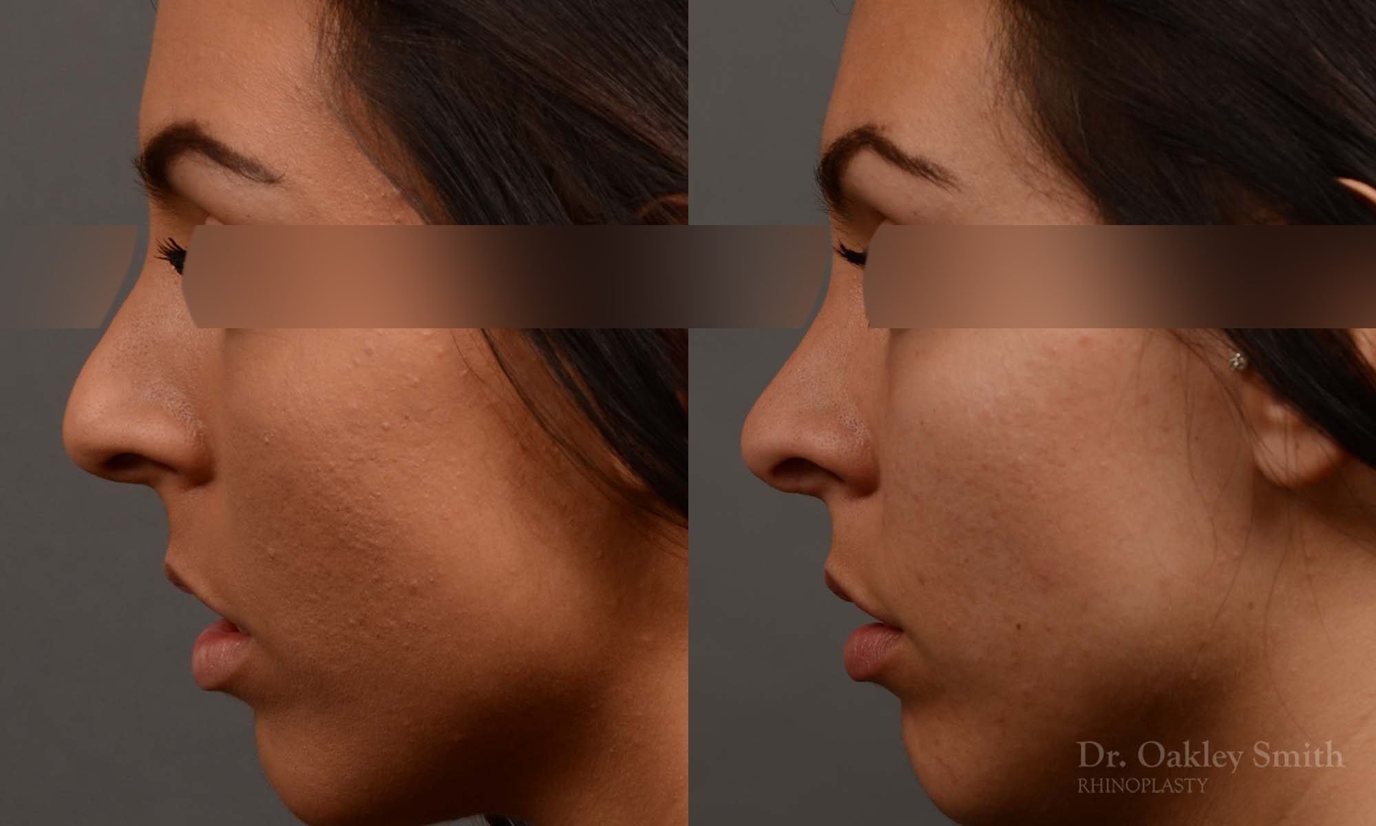rhinoplasty Nothing demonstrates the skillful craftsmanship that Dr. Oakley Smith accomplishes during his surgeries than a collection of before and after case studies. As one of a hand full of surgeons in North America who limits his practice to only Rhinoplasty surgery, it is obvious that he has mastered his art. There is no question why he is one of the busiest cosmetic nose job surgeons in the country.