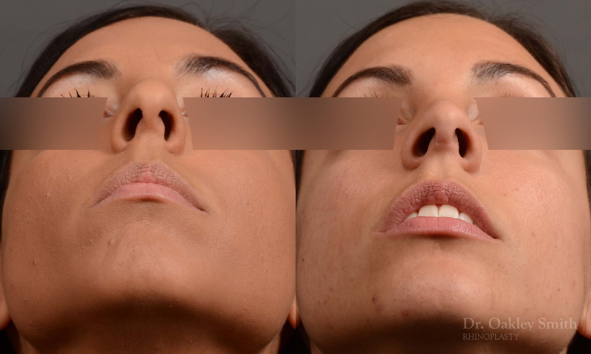 rhinoplasty Nothing demonstrates the skillful craftsmanship that Dr. Oakley Smith accomplishes during his surgeries than a collection of before and after case studies. As one of a hand full of surgeons in North America who limits his practice to only Rhinoplasty surgery, it is obvious that he has mastered his art. There is no question why he is one of the busiest cosmetic nose job surgeons in the country.