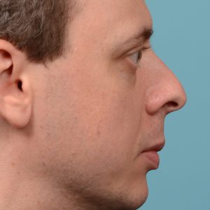 male nose rhinoplasty curved nose