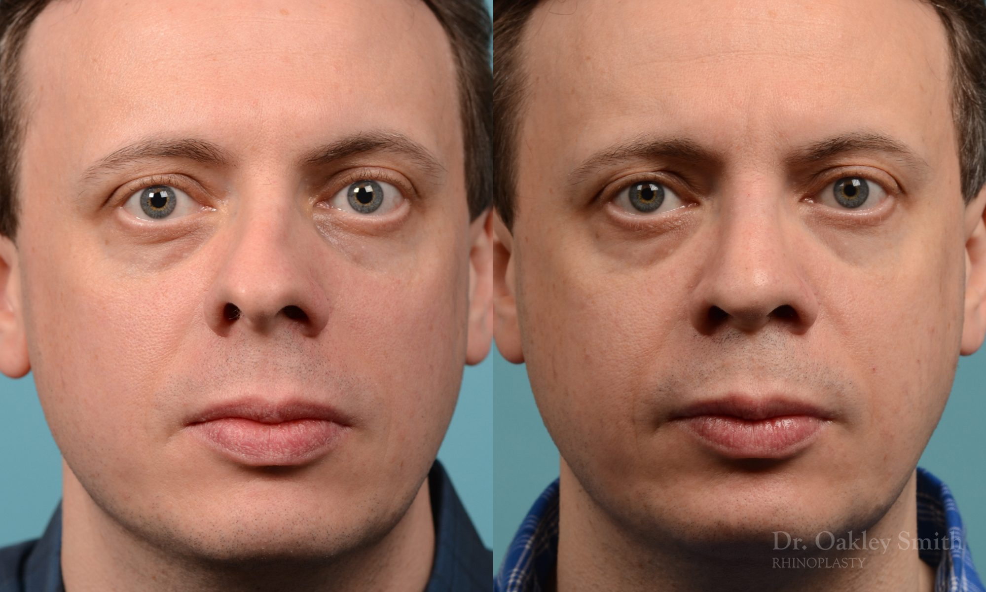 male nose rhinoplasty curved nose