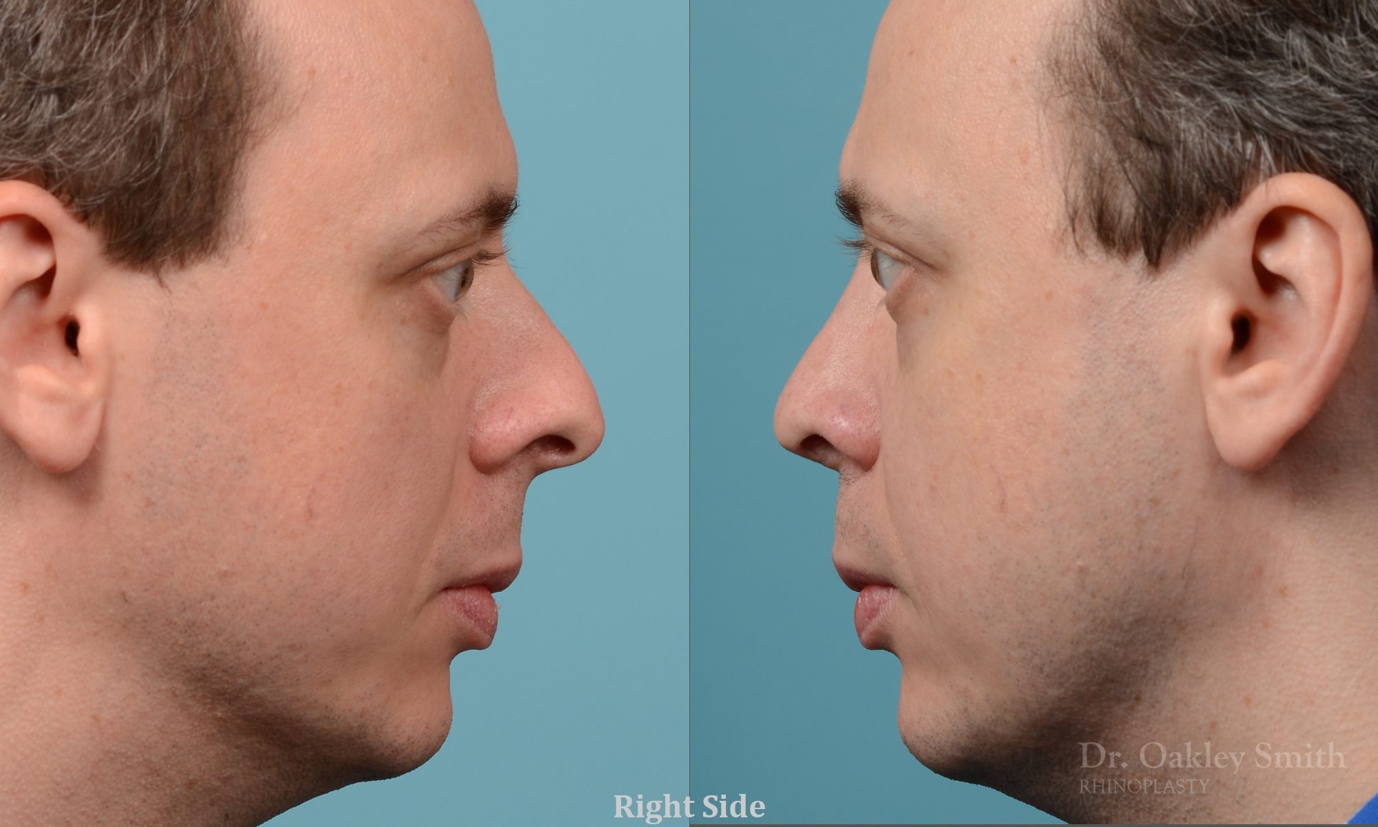male nose rhinoplasty curved nose