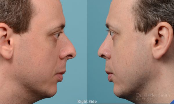 male nose rhinoplasty curved nose