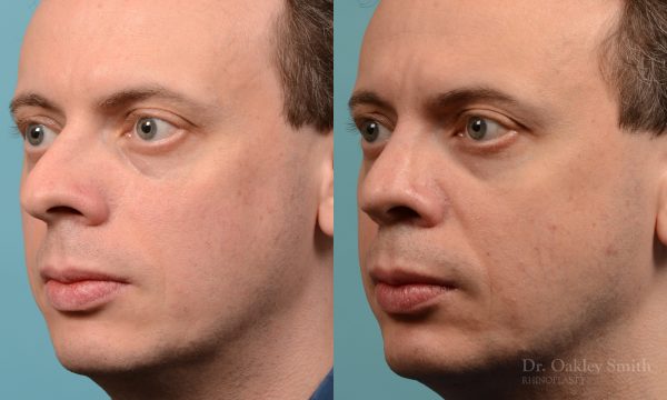 male nose rhinoplasty curved nose